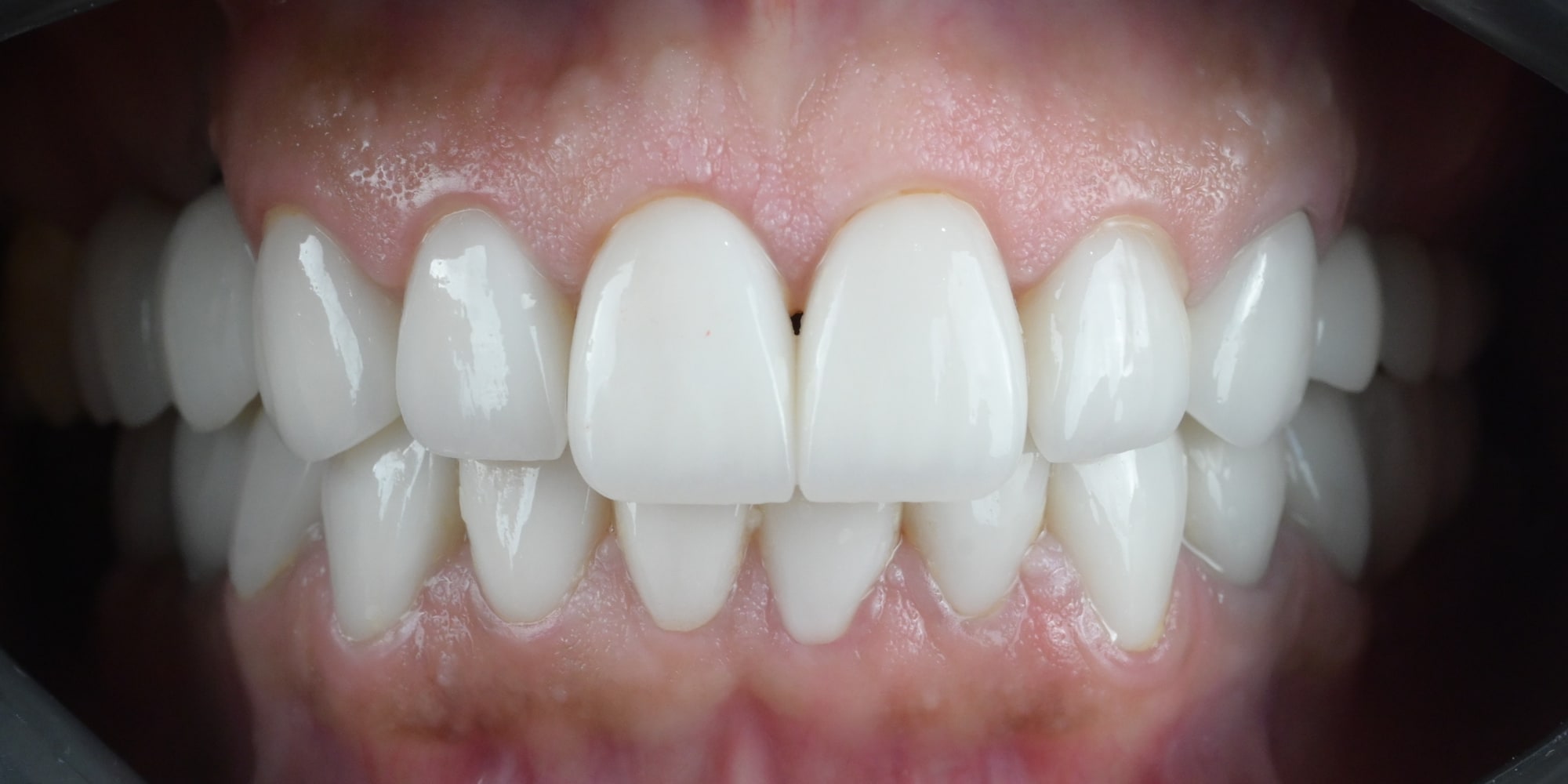 After treatment: the same front view, showing the new upper and lower crowns and the refined gum line.