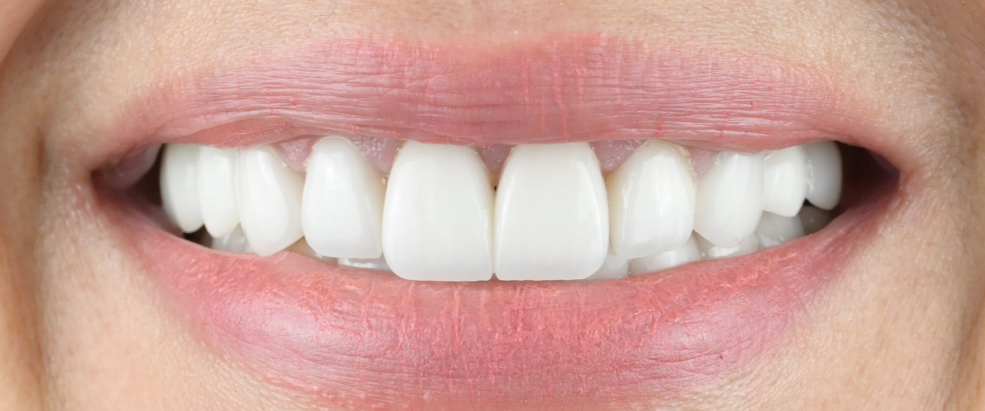 After treatment: the same close view of the smile, with the new crowns in place.
