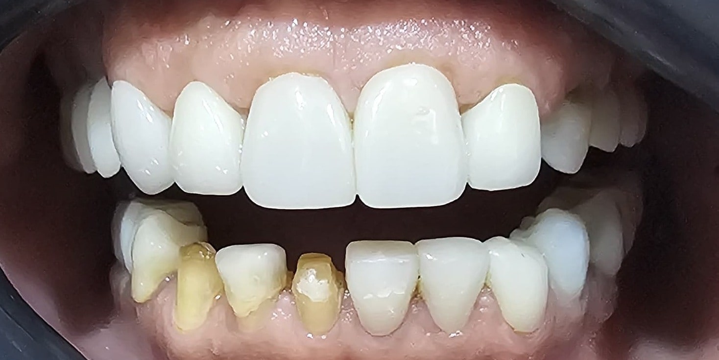 Before treatment: front view of the teeth with the lips held back, showing the existing upper crowns and the discoloured lower teeth.