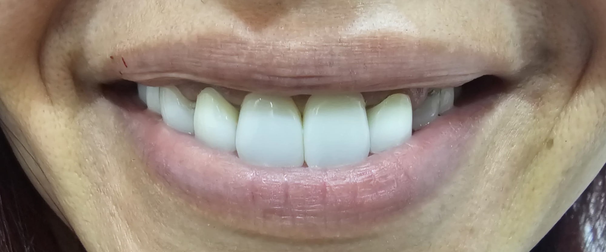 Before treatment: close view of the patient's smile showing the existing crowns.